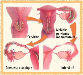 Afflictions causées par le virus du chlamydia chez la femme